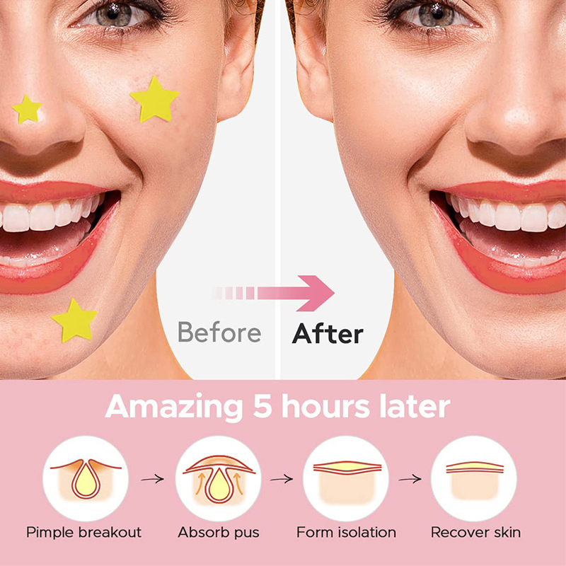 600 PCS/Set Star Pimple Patch  - Beauty Makeup Remover avaliação e preço